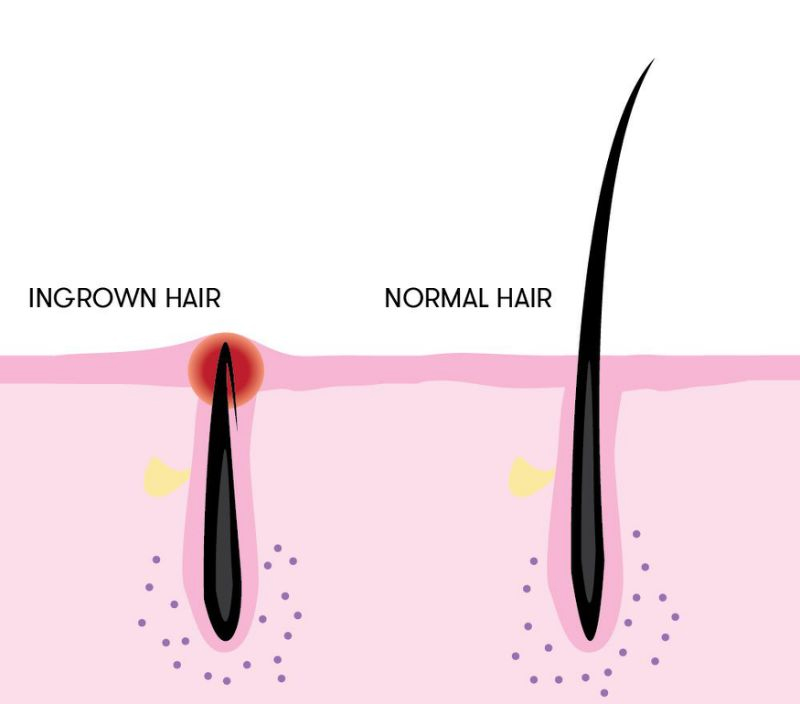 Joe Black Barbershop: Treating Ingrown Facial Hairs - Joe Black Barbershop