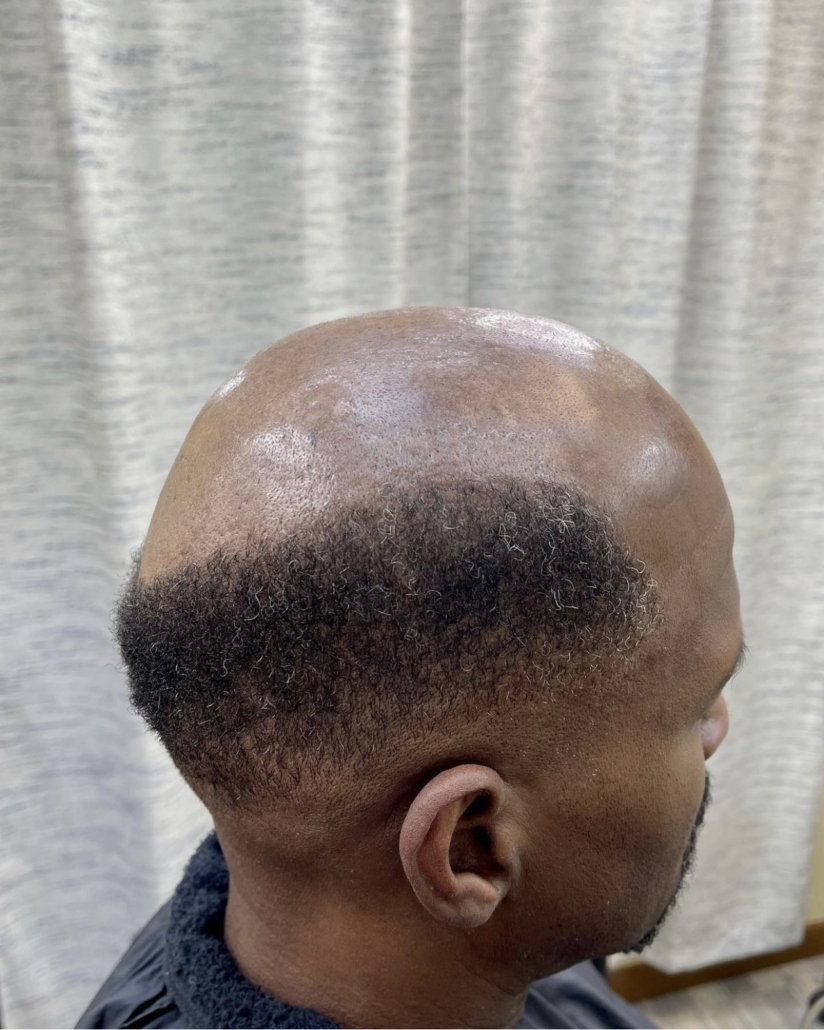 National Hair Loss Awareness Month: Joe Black Barbershop Has the Answer for  Men - Joe Black Barbershop